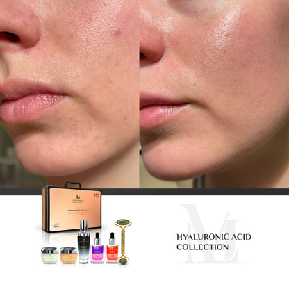 Hyaluronic Acid Collection